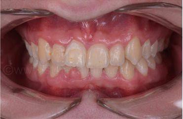 超 保守牙科序列治疗方案 漂白 渗透 充填