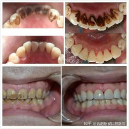 三十年临床经验牙医告诉你,洗牙可以 包治口腔百病 ,但以下几类人不适合