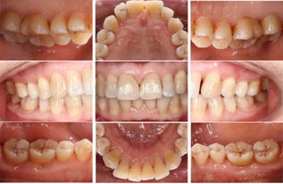 一例牙周牙髓联合病变,提醒我们不要忽视牙周检查和治疗 口腔名医随感录